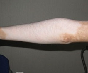 手臂上的白斑是什么要素导致的呢